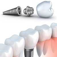 Implante-Dentario-2-Mobile.jpg